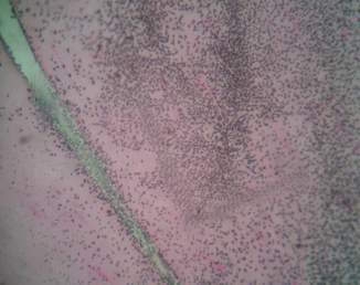 МЫШЕЧНАЯ ТКАНЬ ?В ЗОНЕ ИНЪЕКЦИИ АЛЛОГЕННОГО ГАП